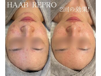 シェア(share.)/ニキビケアにもHAAB REPRO