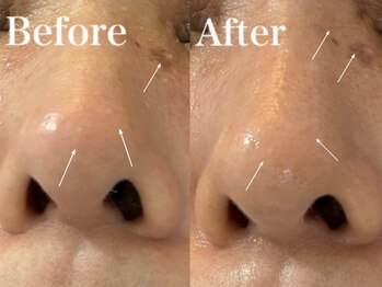 いやしの家さくら/クレンジング洗顔のビフォアフ