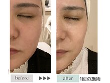 ジェニックサロン グランギンザ 水戸(GENIC SALON GRAND GINZA)/最新リフトケア/たるみ/水戸