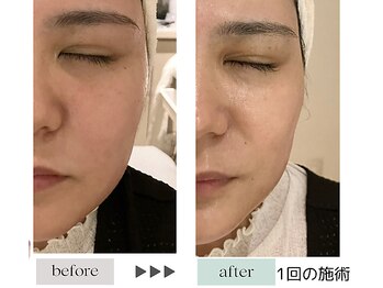ジェニックサロン グランギンザ 水戸(GENIC SALON GRAND GINZA)/最新リフトケア/たるみ/水戸
