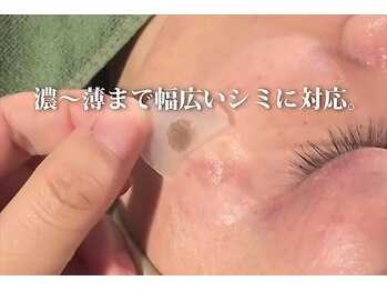 ルアナ(Luana)/シミ改善！透明感のある美肌へ☆