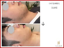 ひかり素肌/ひげ脱毛12回