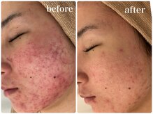 カラン(CALIN)/光で殺菌☆ターンオーバーを正常