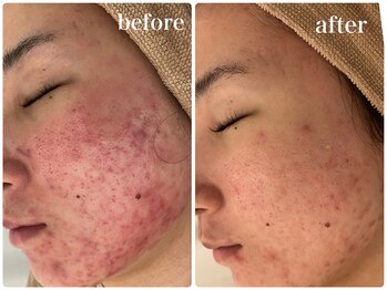 カラン(CALIN)/光で殺菌☆ターンオーバーを正常