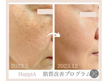 ハピア(HappiA)/Dr.PUR 肌質改善プログラム
