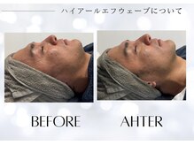 ユアーズ ビューティー(YOURS beauty)/小顔施術1回　ビフォーアフター