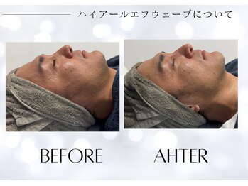 ユアーズ ビューティー(YOURS beauty)/小顔施術1回　ビフォーアフター