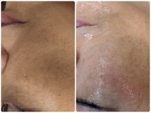 トリプル内から→ハーブ表皮から！交互にしっかり肌質改善！