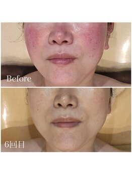 ルノン(Lunon)/《赤ら顔》タラソトリートメント