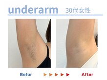 キングスサロン 熊本の雰囲気（脇のポツポツも無くなったら快適♪脇は効果早いとお声頂きます♪）