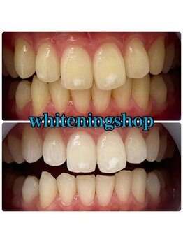 ホワイトニングショップ 天王寺店/40分照射×10回 30代女性