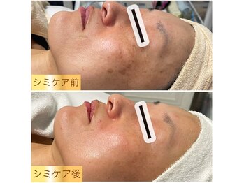 ポノ(pono)/シミケア　カウンセリング