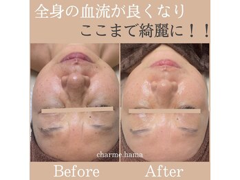 シャルム(Charme.)/陶肌ハーブピーリング+骨格矯正