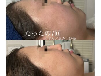 オーシャンブルーム 目黒(OceanBloom)/アンストレス／乳酸菌ピーリング