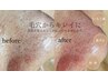 【本格毛穴洗浄】角栓除去！いちご鼻・黒ずみ1発解消！￥10,000