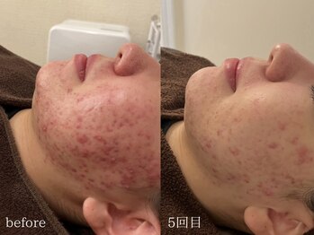 アイル 天王寺店(iru)/肌質改善・ニキビケア