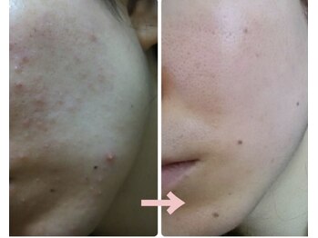 マグノリア/バクチ甦生コース