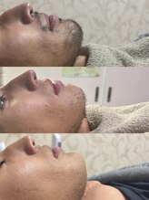 シルビー(CILBE)/ヒゲミックス脱毛