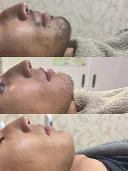 シルビー(CILBE)/ヒゲミックス脱毛