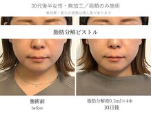 サボラミ(sabor A Mi)/Vライン形成に効果◎