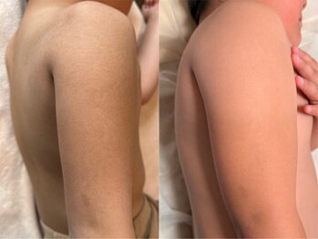 Private salon Luck【プライベートサロンラック】の写真/【看護師在籍】夏までに間に合う痛みの少ない脱毛☆小学生のキッズから介護脱毛まで大歓迎♪
