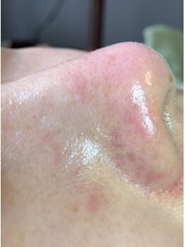 リンカ(Rinca)/つるん♪毛穴エクストラクション