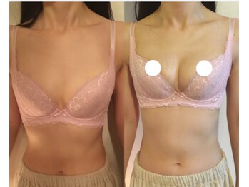 カナエルサロン 旭川(KANAERU SALON)/【バストアップ】症例☆