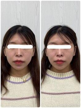 ラフテル鍼灸整骨院/肌の不調に美容鍼がおすすめ！