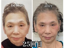 小顔22 ボルティ 赤坂支店(Bolty)/【悩み】70代：顔の左右差