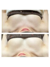 エヌ(N)/施術１回でこの結果！！