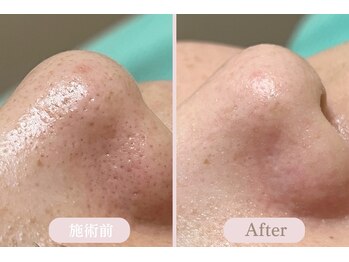 エピル(EPIL)/DEEPクリアスキン毛穴洗浄症例