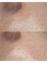 アマト 心斎橋店(Amato)/心斎橋/毛穴洗浄/ワックス脱毛