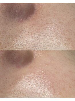 アマト 心斎橋店(Amato)/心斎橋/毛穴洗浄/ワックス脱毛