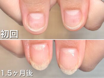 グラシュータン(gracieux temps)/【深爪矯正13000円】