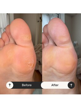 マオヌー(MAONU)/式足裏角質ケア　症例写真