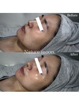 ナチュールムーン(Nature moon.)/ハーブピーリング