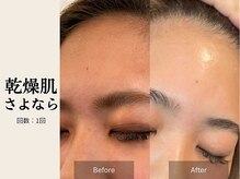 サロン ルイス アディクト(salon Lewis Addict)/ハーブピーリング