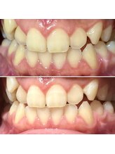 ビーバイビー(BBYB)/初回ホワイトニング実例♪