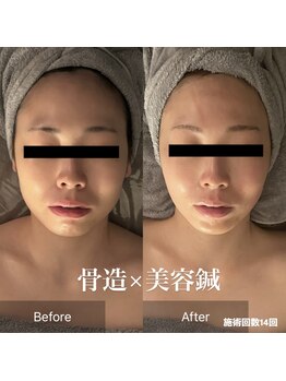 サロンリーナ 銀座店(SalonLena)/骨造×美容鍼