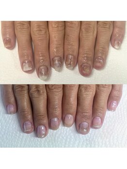 ウェルズユキ(well's yuki)/爪下出血/剥離した爪/痒み