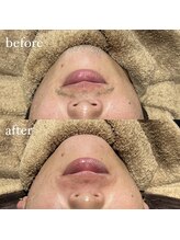 ユウユウ(YUYU)/ヒゲ：艶の極み脱毛