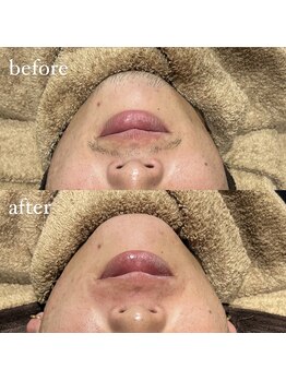 ユウユウ(YUYU)/ヒゲ:艶の極み脱毛