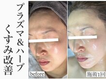 レイ(Rey)の雰囲気（ピーリング不要|お肌を強く輝く肌に補正するのが最高峰プラズマ）