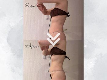 サイバーエステ 宇都宮店/お腹ぽっこり→サイズダウン