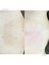 イチロクイチハチ(1618)/挙式前の背中ニキビもお任せ