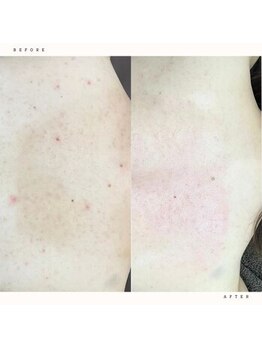 イチロクイチハチ(1618)/挙式前の背中ニキビもお任せ