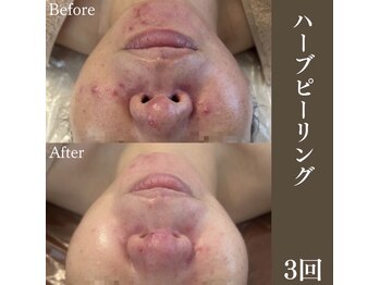 サロンドペシェ(salon de peche)/繰り返すニキビにはハーブ!