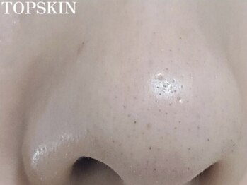 トップスキン 久屋大通(TOPSKIN)/ハーブピーリングでいちご鼻卒業