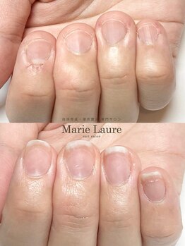 マリーロール 梅田店(Marie Laure)/自爪育成/深爪矯正/ネイルケア
