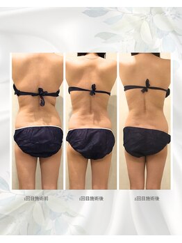 コンビンス(convince)/痩身ダイエットメニュー